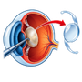 Cataract Surgery with IOL Implantation (Phaco Emulsification, Abbott Medical Optics, USA & Moller Wedel Haag Streit Microscope, Germany)