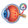 Glaucoma Diagnosis & Treatment