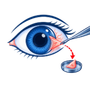 Pterygium Surgery